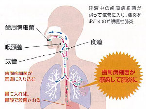 じじぃの 未解決ファイル 219 歯周病菌 Cool Hira S Diary